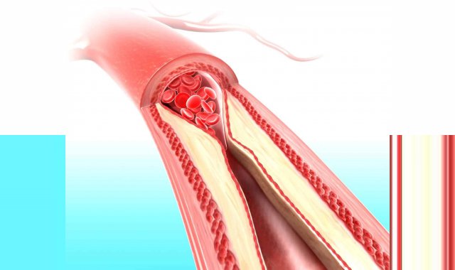 How to clean your blood vessels How to clean your blood vessels