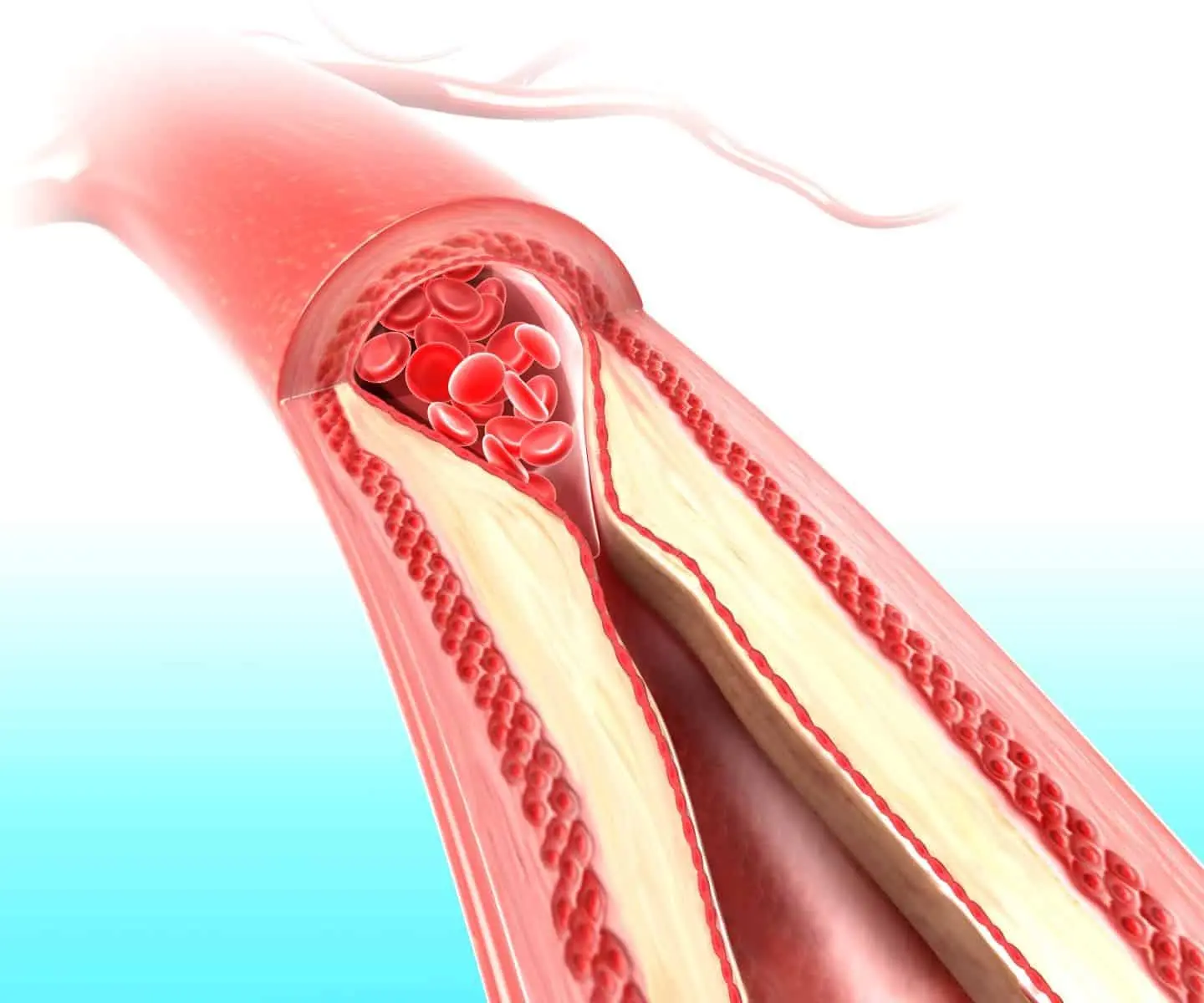 How to clean your blood vessels